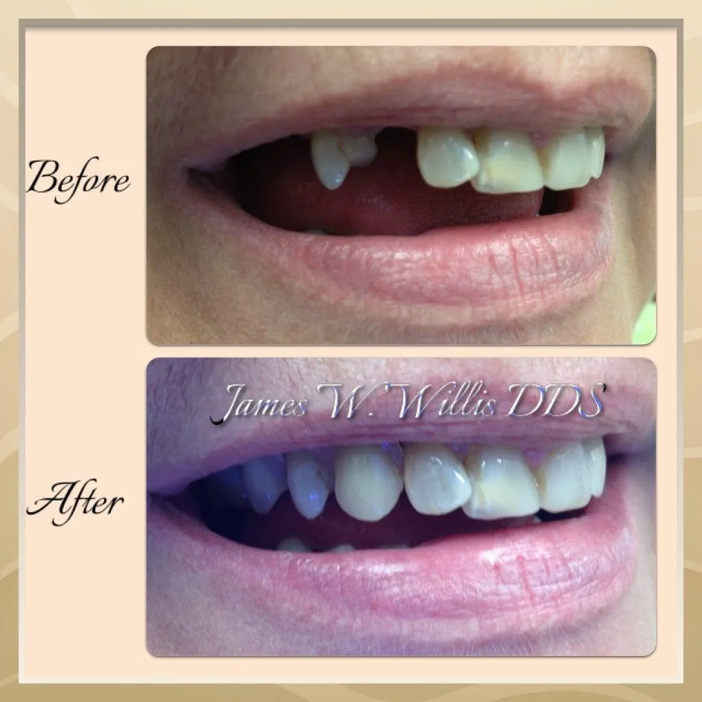 Before-and-after smile transformation, case 1, a cosmetic case treated by Dr. James Willis