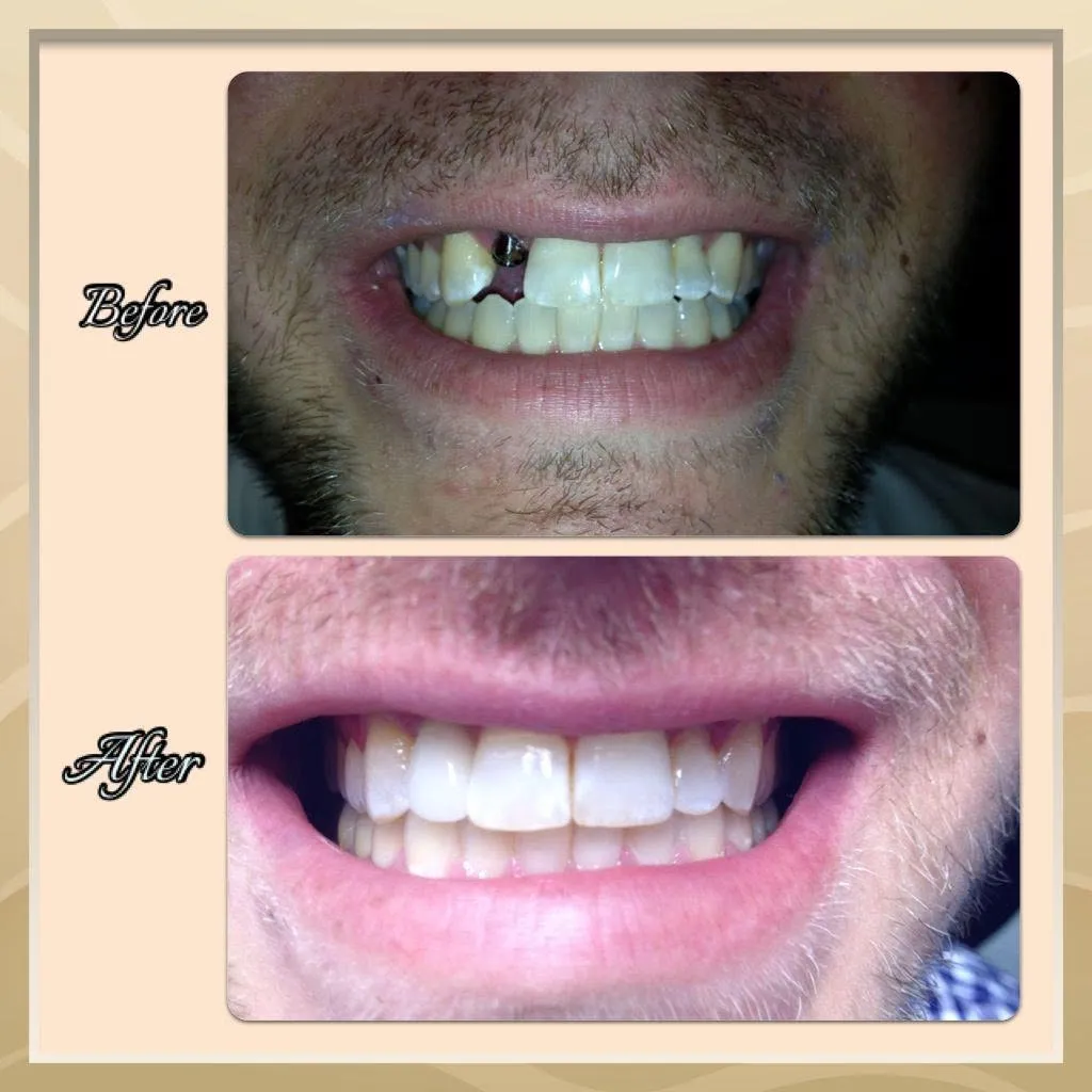 Before-and-after smile transformation, case 2, a cosmetic case treated by Dr. James Willis