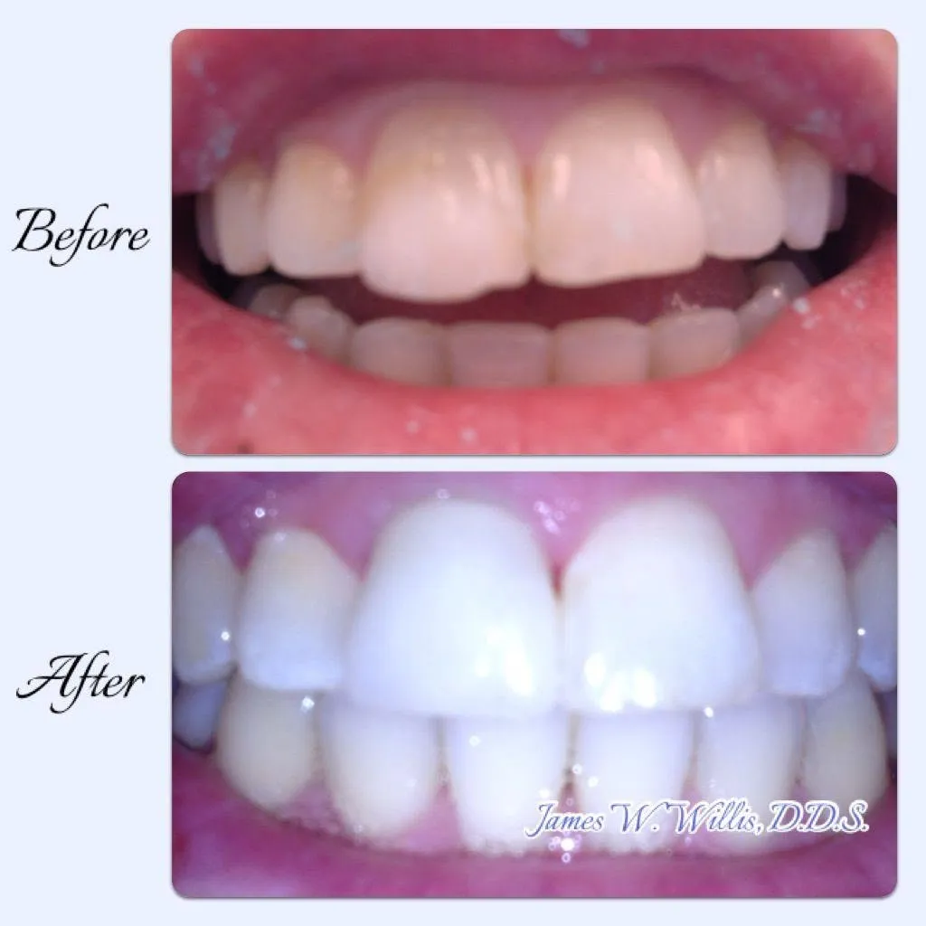 Before-and-after smile transformation, case 3, a cosmetic case treated by Dr. James Willis