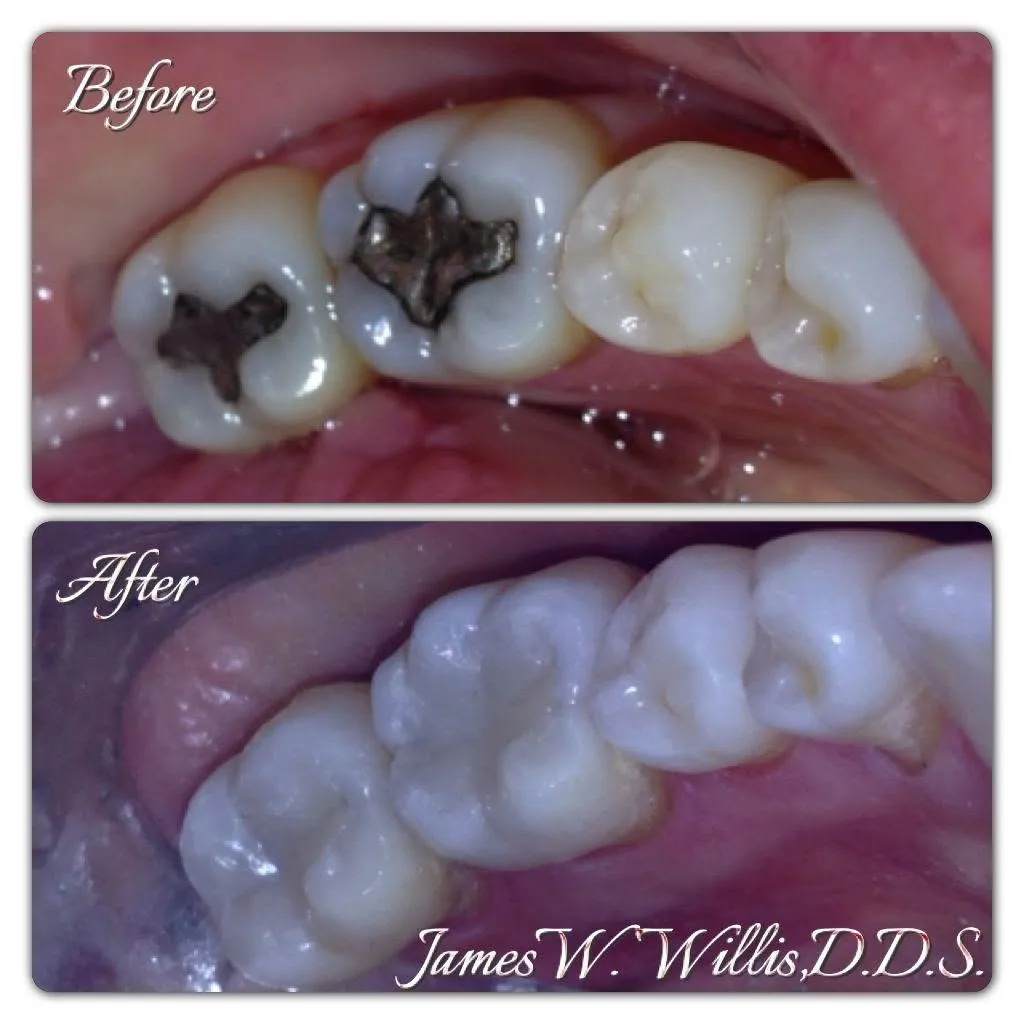 Before-and-after smile transformation, case 4, a cosmetic case treated by Dr. James Willis