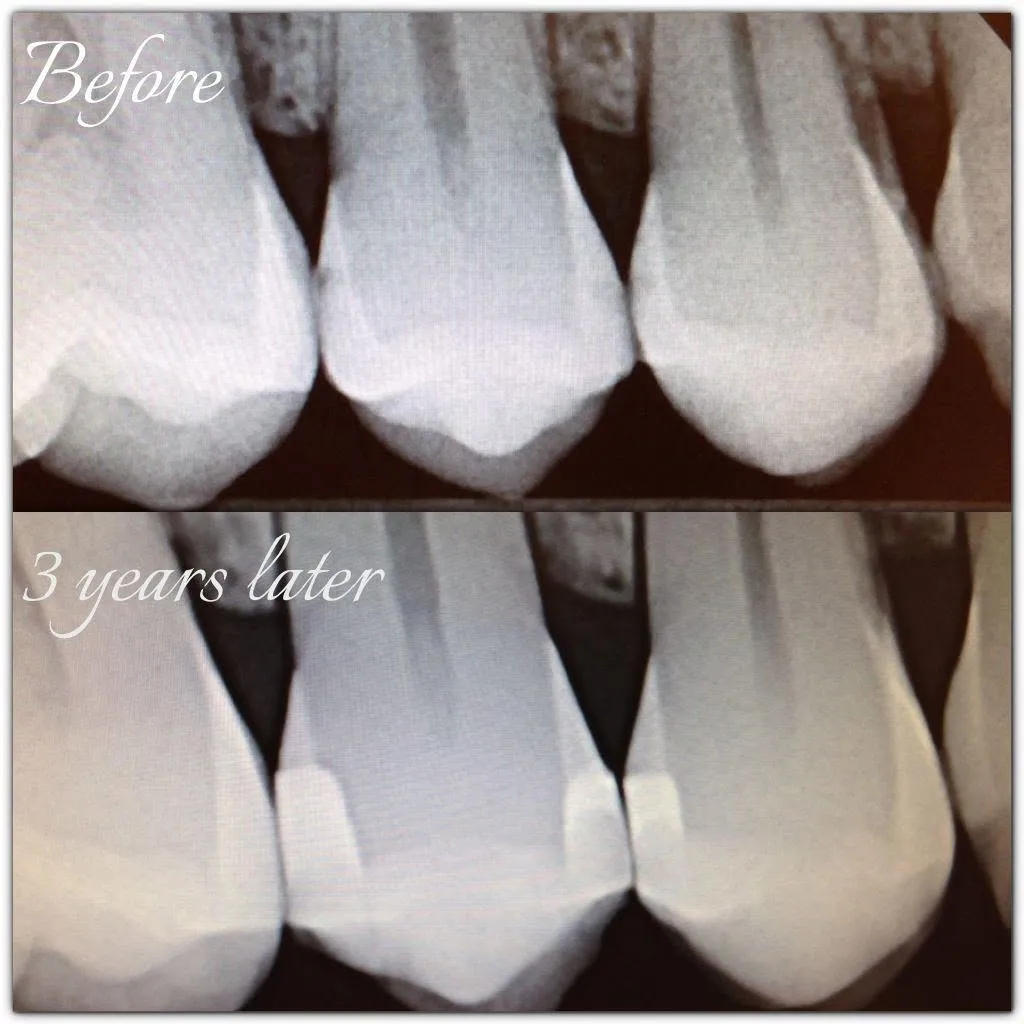Before-and-after smile transformation, case 5, a cosmetic case treated by Dr. James Willis