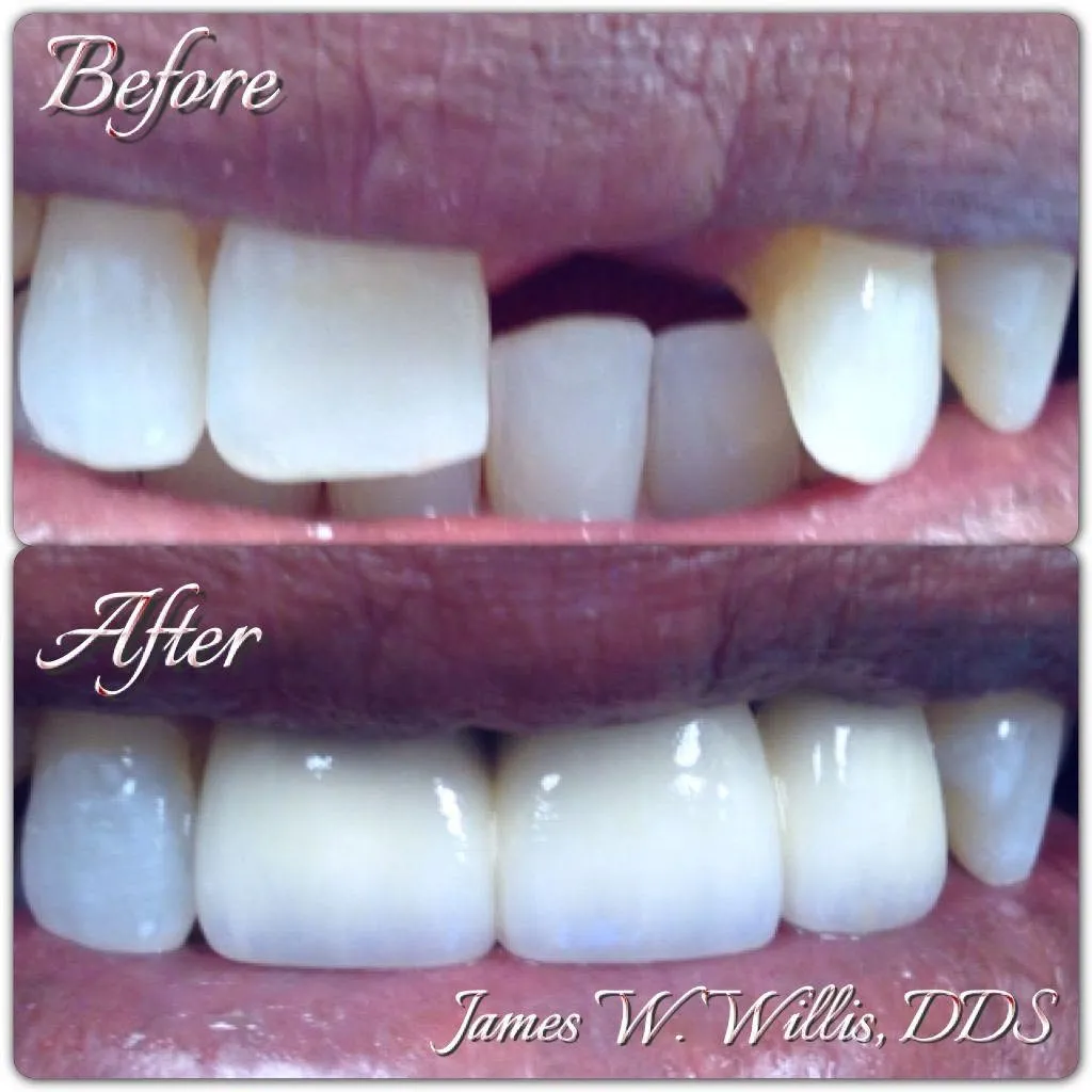 Before-and-after smile transformation, case 6, a cosmetic case treated by Dr. James Willis