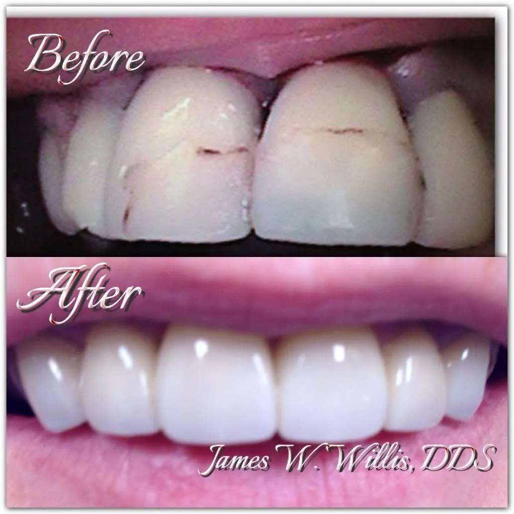 Before-and-after smile transformation, case 7, a cosmetic case treated by Dr. James Willis