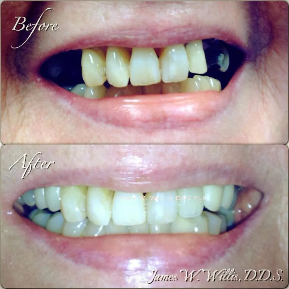 Before-and-after smile transformation, case 8, a cosmetic case treated by Dr. James Willis