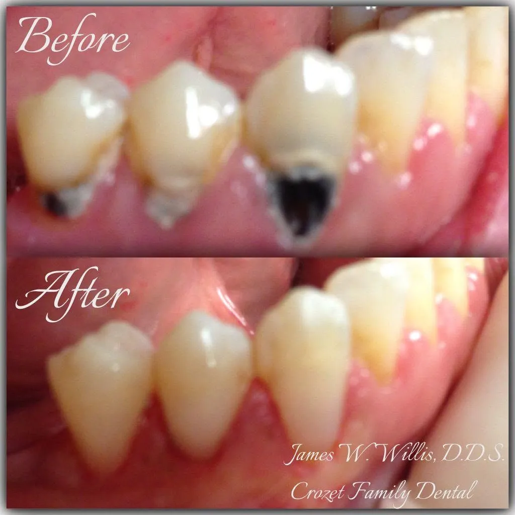 Before-and-after smile transformation, case 9, a cosmetic case treated by Dr. James Willis