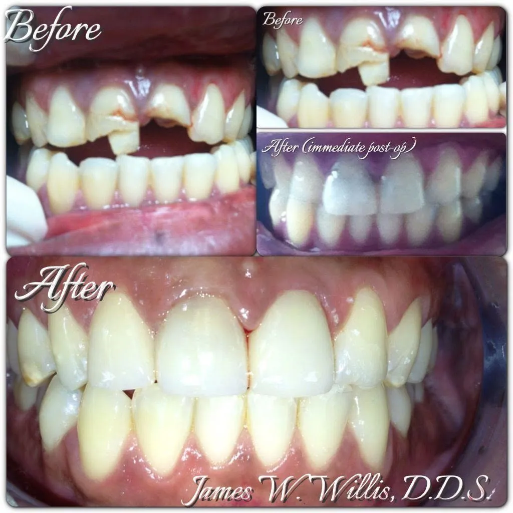 Before-and-after smile transformation, case 10, a cosmetic case treated by Dr. James Willis