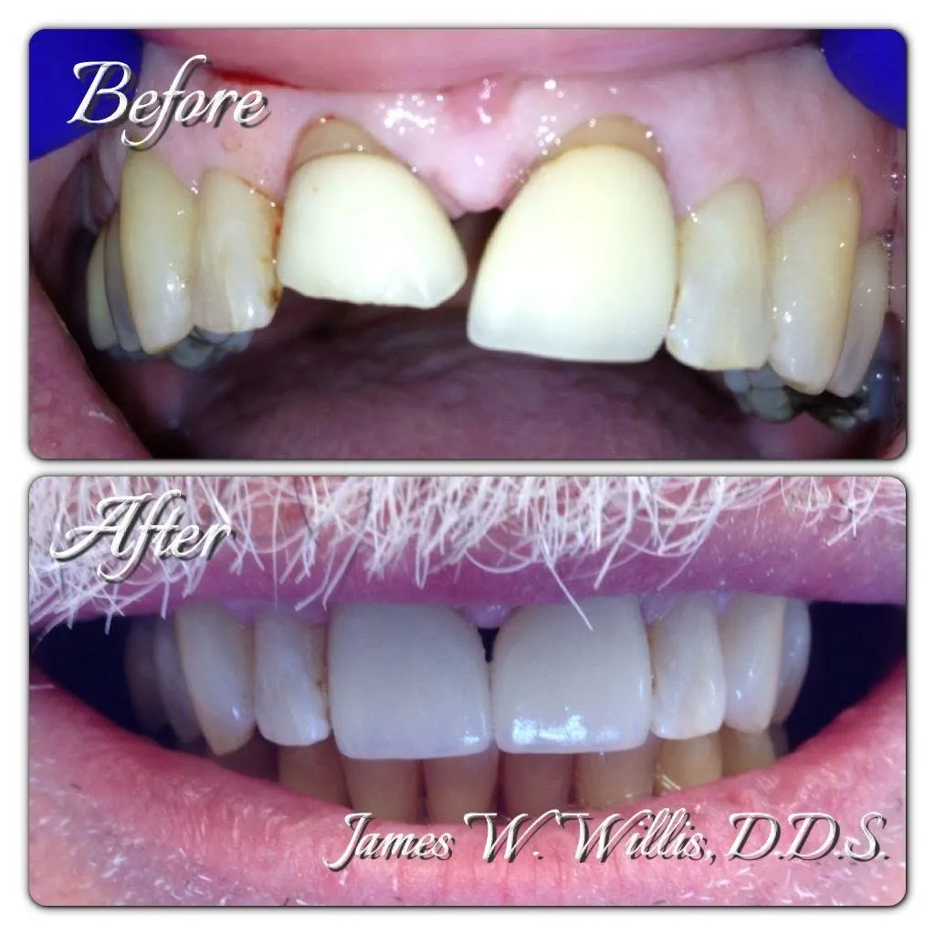 Before-and-after smile transformation, case 11, a cosmetic case treated by Dr. James Willis
