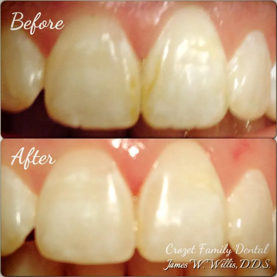 Before-and-after smile transformation, case 12, a cosmetic case treated by Dr. James Willis
