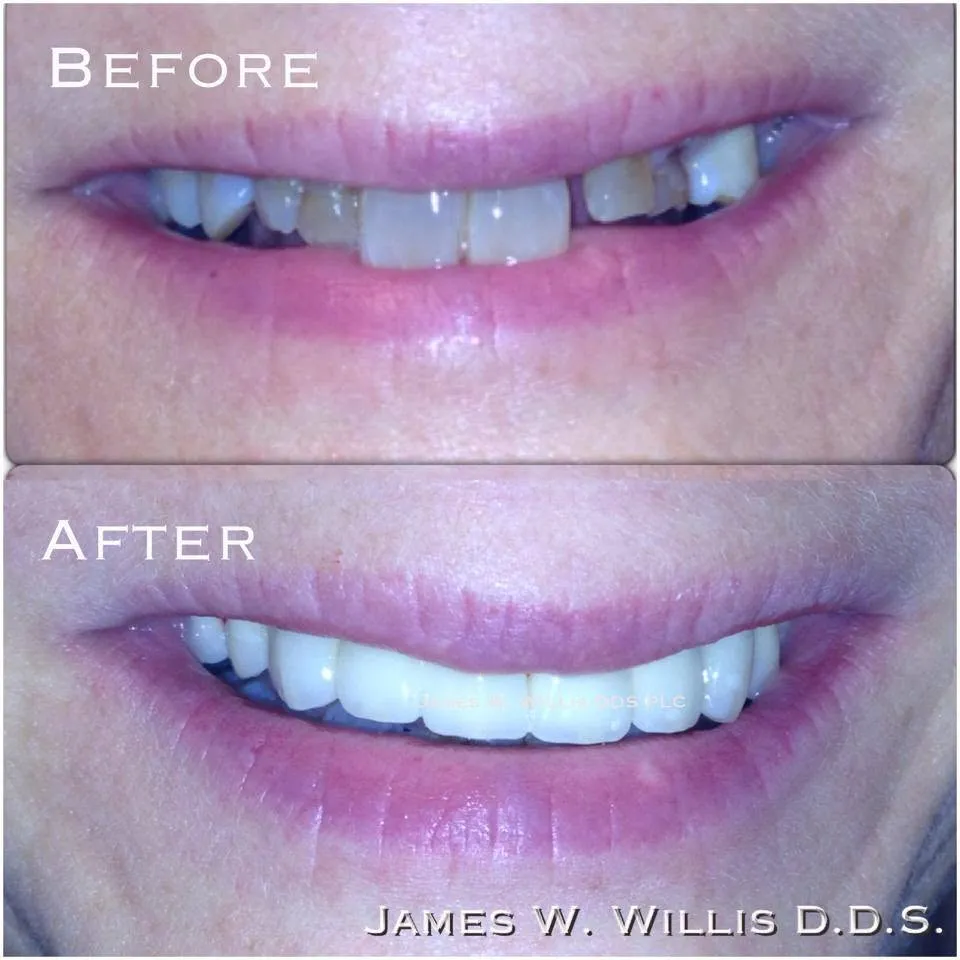 Before-and-after smile transformation, case 13, a cosmetic case treated by Dr. James Willis