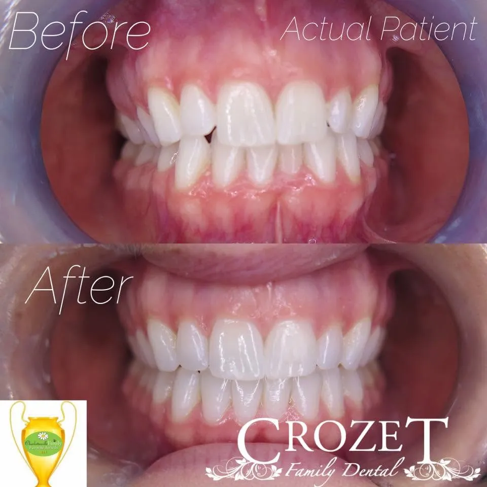 Before-and-after smile transformation, case 14, a cosmetic case treated by Dr. James Willis