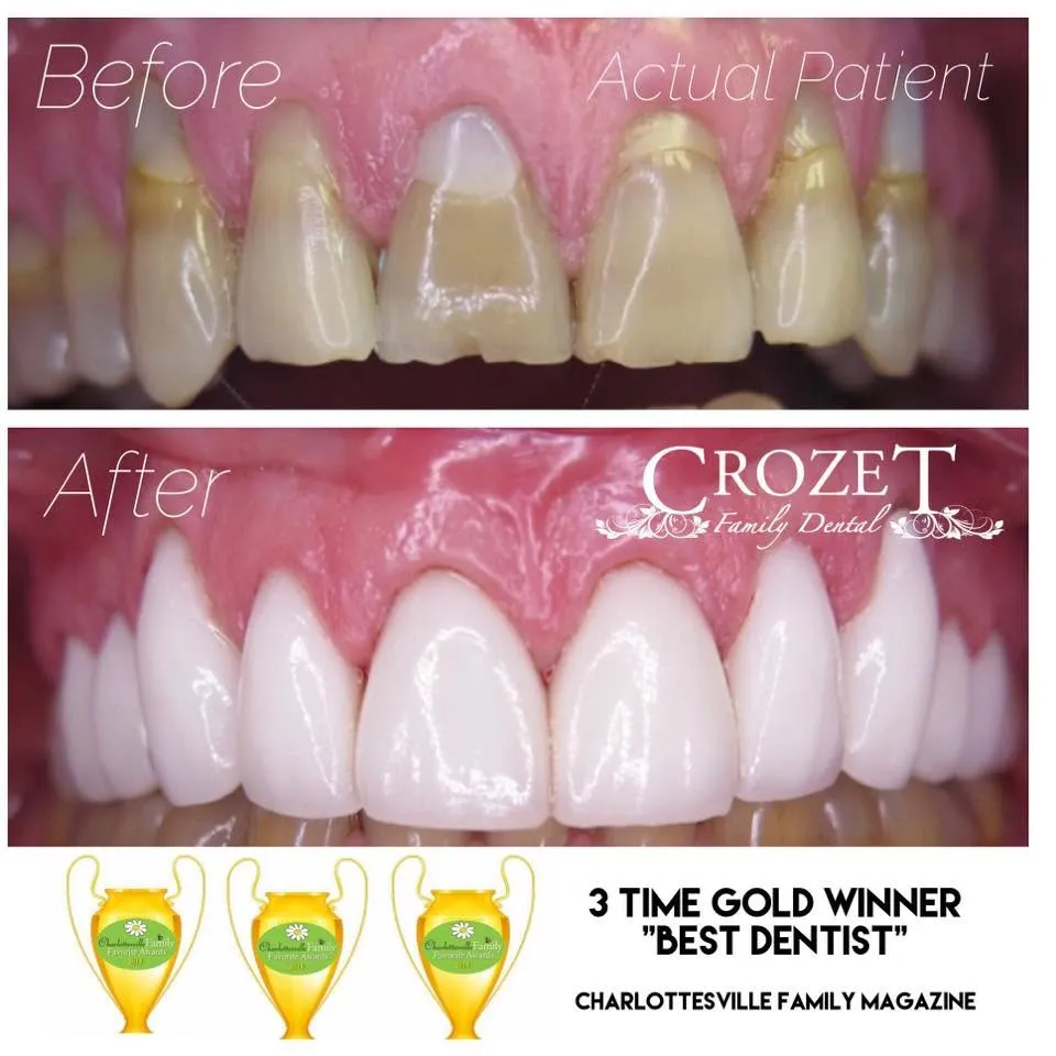 Before-and-after smile transformation, case 15, a cosmetic case treated by Dr. James Willis