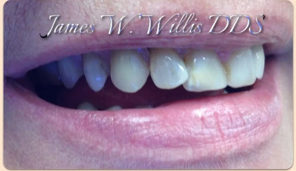 A smile transformation treated by Dr. James Willis